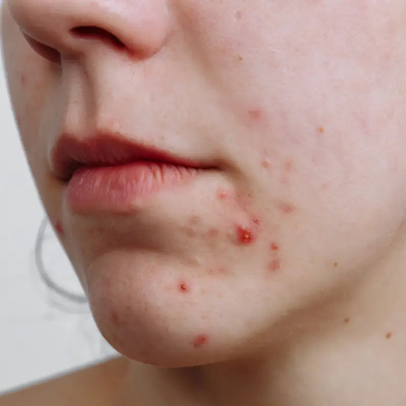 Woman with acne on face